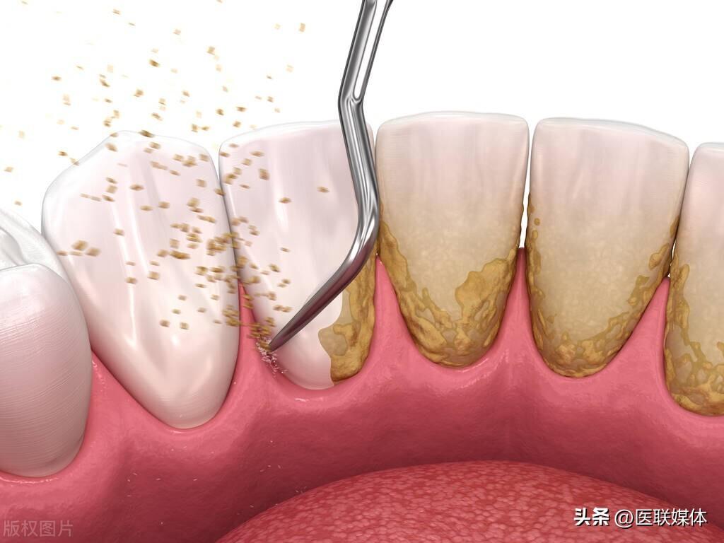 牙缝里长了牙结石，能不能自己抠掉？(图3)